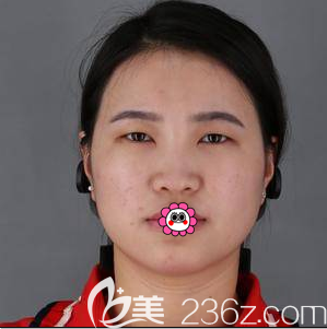 我在北京丽都做面部自体脂肪填充第31天效果