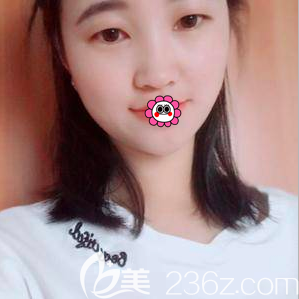 北京米兰柏羽丽都自体脂肪填充技术怎么样？我在北京米兰柏羽丽都做面部脂肪填充效果告诉你