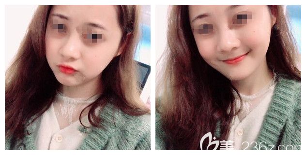 原以为自己的大脸瘦脸就能改善，面诊过医生才知道脂肪型得做面部吸脂，术后10天针眼就看不见了