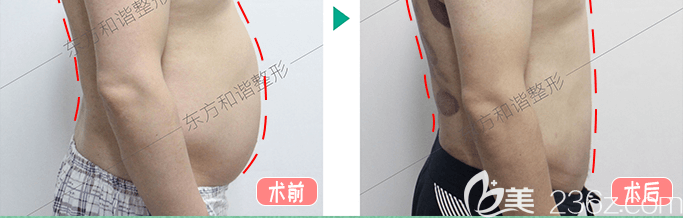 <!--<i data=20240703-sp></li>
<li><i data=20240703-sp></i>-->和谐冯庆亮医生腰腹吸脂案例