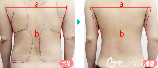 <!--<i data=20240703-sp></li>
<li><i data=20240703-sp></i>-->和谐冯庆亮医生后背吸脂案例