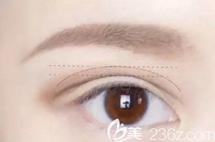 清潭first整形外科医院成镇模双眼皮修复技术