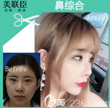 淄博美联臣隆鼻案例 淄博美联臣隆鼻案例