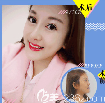 <!--<i data=20240703-sp></li>
<li><i data=20240703-sp></i>-->隆鼻案例