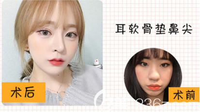 <!--<i data=20240703-sp></li>
<li><i data=20240703-sp></i>-->隆鼻案例