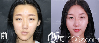 <!--<i data=20240703-sp></li>
<li><i data=20240703-sp></i>-->隆鼻案例