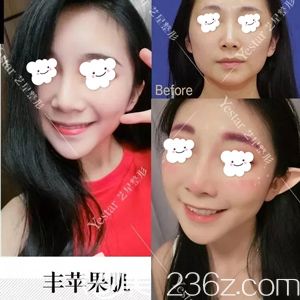 武汉艺星做自体脂肪填充苹果肌术后恢复效果 武汉艺星做自体脂肪填充苹果肌术后恢复效果