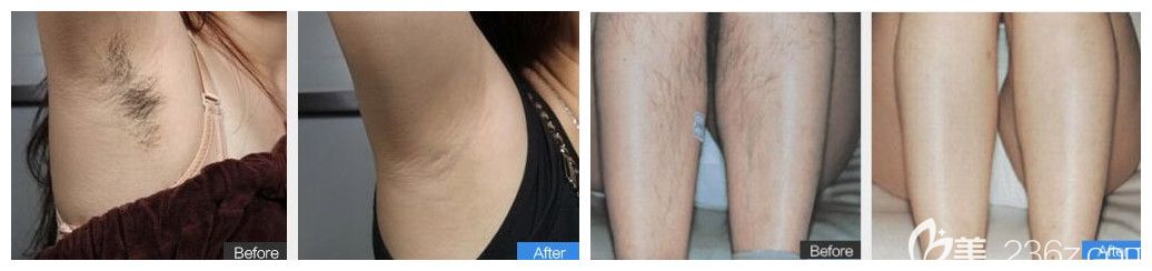 相山时光腋窝+小腿脱发案例效果对比照片