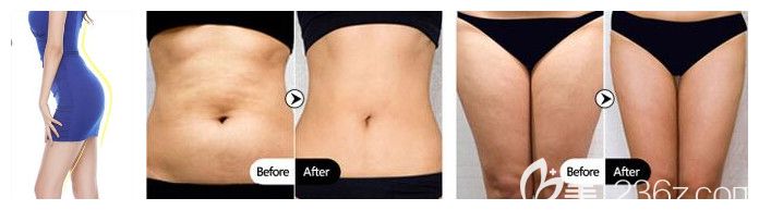 时光吸脂腰腹+大腿吸脂及臀部脂肪填充案例效果对比