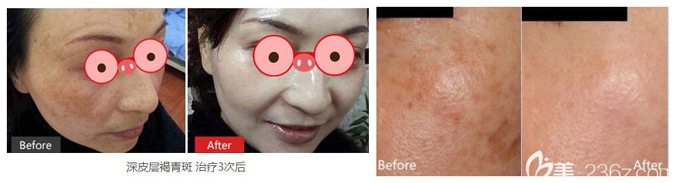 淮北哪里祛斑好？时光整形激光祛斑案例来验证