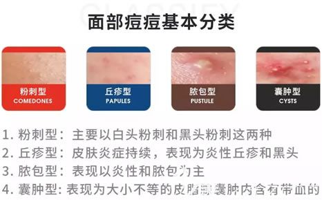 面部痘痘的四大类型
