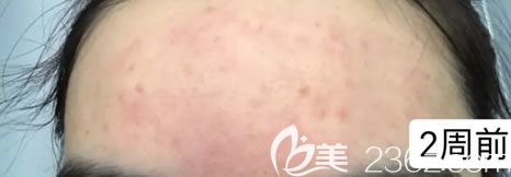 在宁波薇琳做水杨酸祛痘前