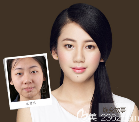 整形医院李鹏医生双眼皮案例 整形医院李鹏医生双眼皮案例