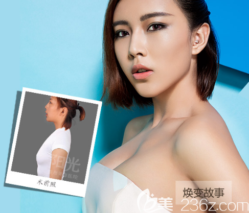 整形医院李映雨院长隆胸案例 整形医院李映雨院长隆胸案例