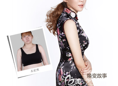 整形医院陈星光全身吸脂案例 整形医院陈星光全身吸脂案例