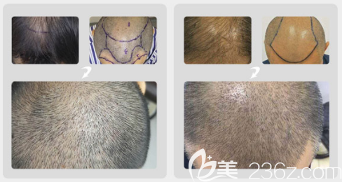 整形医院杨浩东头发种植案例 整形医院杨浩东头发种植案例