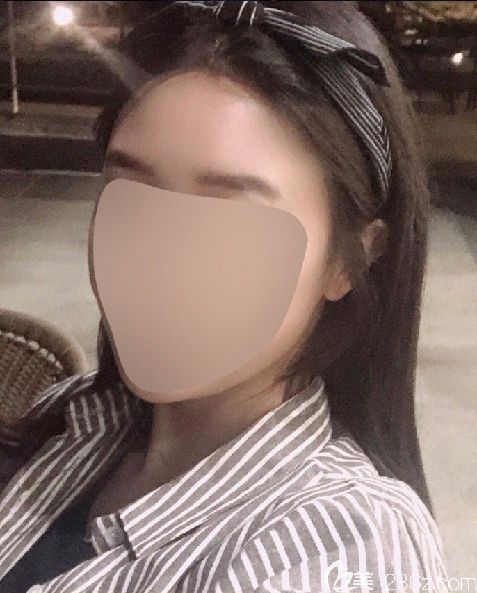 韩国芭堂旻长焕额头缩小感觉缩小了很多疤痕很细，总之满意推荐