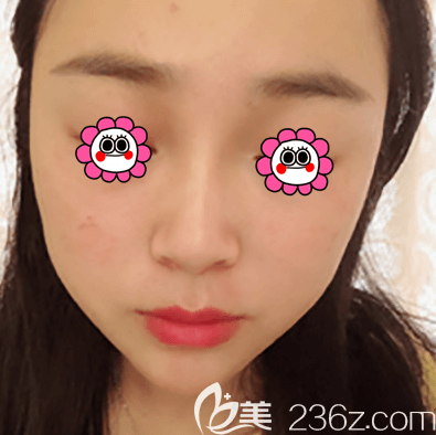 我在北京紫洁医美做超皮秒祛斑美肤第7天效果