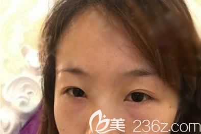 在宁波建国医美做去眼袋术前 在宁波建国医美做去眼袋术前