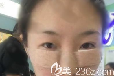 宁波建国整形刚做完去眼袋图片 宁波建国整形刚做完去眼袋图片