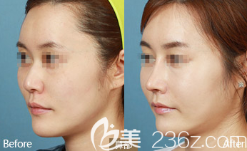 德州友谊隆鼻案例2