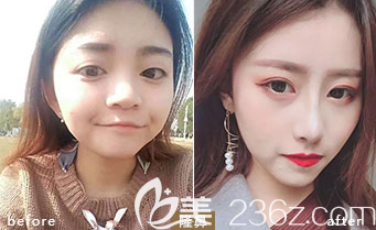 德州友谊隆鼻案例3