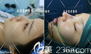 德州友谊隆鼻案例4