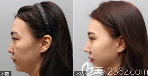 德州天宏假体隆鼻案例1