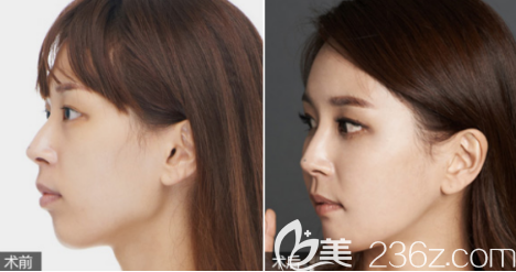 德州天宏假体隆鼻案例2