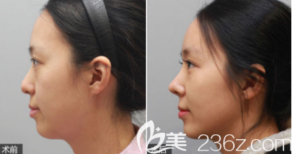 德州天宏假体隆鼻案例3