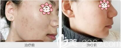 十堰安琪儿做皮秒激光祛斑术前术后对比效果 十堰安琪儿做皮秒激光祛斑术前术后对比效果