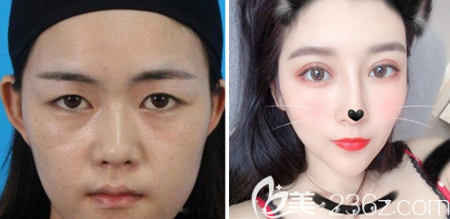 深圳润泽瑞尼丝刘庚博士双眼皮案例