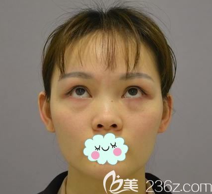 生活习惯不好导致眼袋提前出现 生活习惯不好导致眼袋提前出现