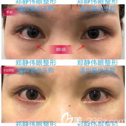 <!--<i data=20240703-sp></i>-->刚做完去眼袋效果 <!--<i data=20240703-sp></i>-->刚做完去眼袋效果