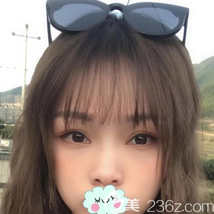 拜拜,眼袋君,我在整形做内切去眼袋全记录,没眼袋后真是太美好了