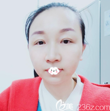 广州曙光陈天雷线雕提升15天恢复过程图 广州曙光陈天雷线雕提升15天恢复过程图