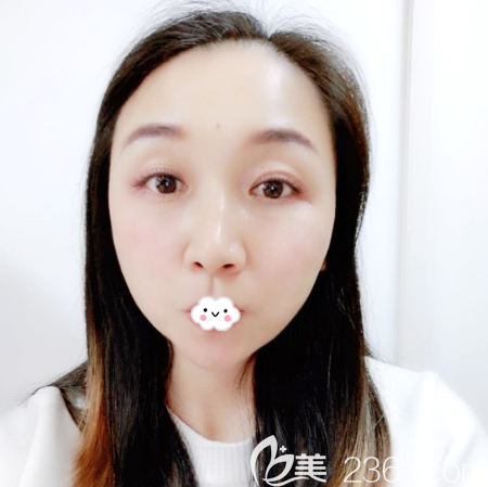 面部线雕埋线提升术后1个月效果图 面部线雕埋线提升术后1个月效果图