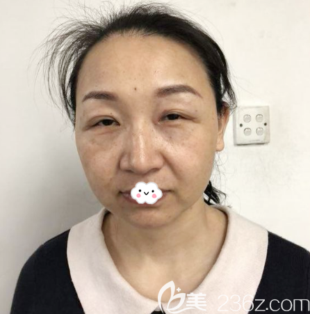 在广州曙光做线雕提升术前照片 在广州曙光做线雕提升术前照片