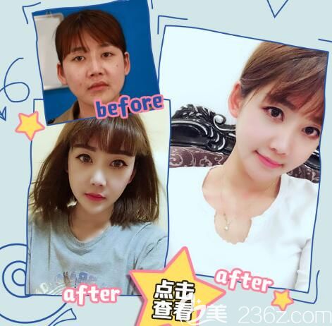 分享注射瘦脸案例 分享注射瘦脸案例