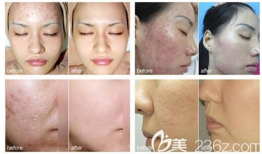 祛痘对比照 祛痘对比照