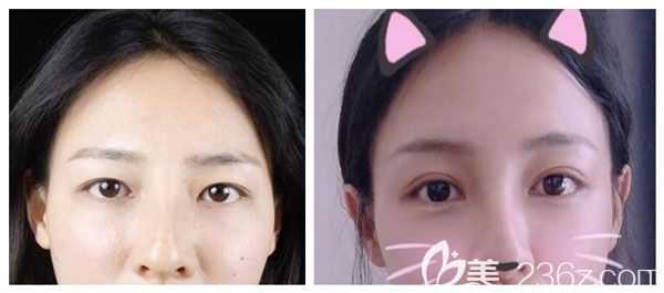 赵宏宇医生改善内眦赘皮做八度美眼术案例效果图