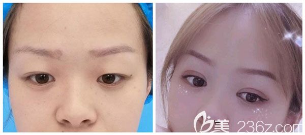周诚做全切双眼皮+开眼角+上睑提肌案例效果对比图