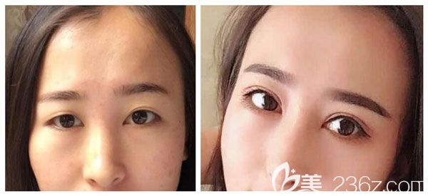 潘贰做双眼皮失败修复案例效果