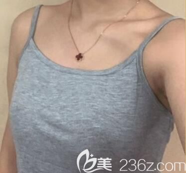 我在玉林华美整形做隆胸术前 我在玉林华美整形做隆胸术前