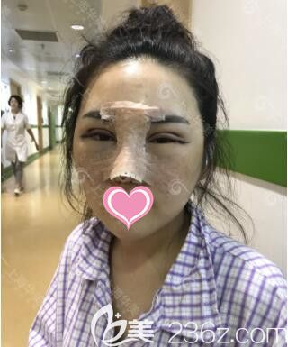上海华美叶丽萍眼综合修复+鼻综合真人案例术后第3天
