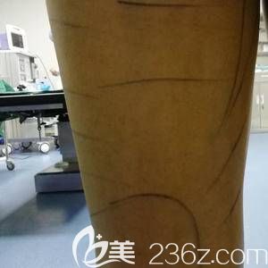 大象腿吸个脂 大象腿吸个脂