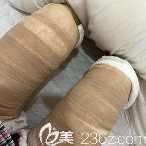 第二天腿上还包着绷带 第二天腿上还包着绷带