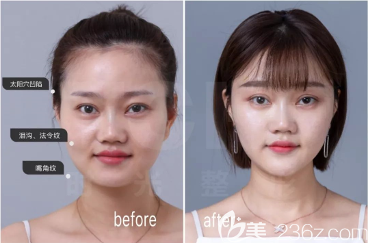 重庆时光公主玻尿酸填充<span style=