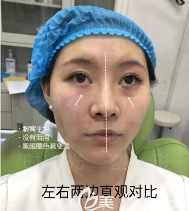 眼周小熨斗术前术后<span style=
