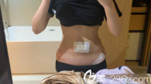 腰腹环吸1700ml：韩国babiline整形郑熙妍女院长目前来看满意